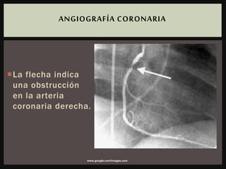 La flecha indica
una obstrucción
en la arteria
coronaria derecha.
ANGIOGRAFÍA CORONARIA
www.google.com/images.com
 