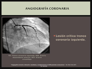 TCI: Tronco coronaría izquierda; ADA: Artería
descendente anterior; ACX: Artería
circunfleja.
 Lesión crítica tronco
coronaría izquierda.
ANGIOGRAFÍA CORONARIA
“Angiografía coronaria: indicación, resultados y complicaciones en 5.000 pacientes consecutivos”, Rev Méd Chile 2007;
135: 829-838
 