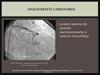 PAC: Puente o bypass aortocoronario; CX:
Arteria circunfleja.
 Lesión severa de
puente
aortocoronario a
arteria circunfleja.
ANGIOGRAFÍA CORONARIA
“Angiografía coronaria: indicación, resultados y complicaciones en 5.000 pacientes consecutivos”, Rev Méd Chile 2007;
135: 829-838
 