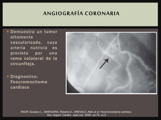  Demuestra un tumor
altamente
vascularizado, cuya
arteria nutricia es
provista por una
rama colateral de la
circunfleja.
 Diagnostico:
Feocromocitoma
cardiaco
ANGIOGRAFÍA CORONARIA
KNOP, Gustavo L., MARGARIA, Roberto A., AREVALO, Aldo et al. Feocromocitoma cardíaco.
Rev. Argent. Cardiol., sept./oct. 2006, vol.74, no.5
 