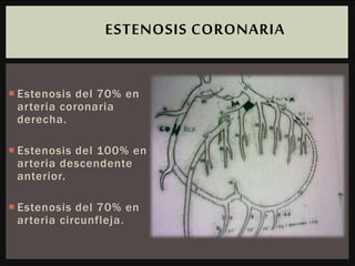  Estenosis del 70% en
arteria coronaria
derecha.
 Estenosis del 100% en
arteria descendente
anterior.
 Estenosis del 70% en
arteria circunfleja.
ESTENOSIS CORONARIA
 