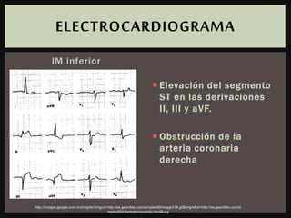 IM inferior
 Elevación del segmento
ST en las derivaciones
II, III y aVF.
 Obstrucción de la
arteria coronaria
derecha
ELECTROCARDIOGRAMA
http://images.google.com.mx/imgres?imgurl=http://es.geocities.com/simplex59/image319.gif&imgrefurl=http://es.geocities.com/si
mplex59/infartodemiocardio.html&usg
 