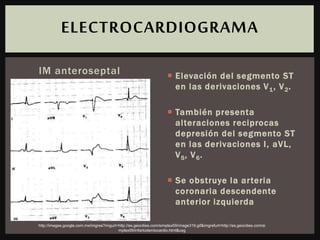 IM anteroseptal  Elevación del segmento ST
en las derivaciones V1, V2.
 También presenta
alteraciones reciprocas
depresión del segmento ST
en las derivaciones I, aVL,
V5, V6.
 Se obstruye la arteria
coronaria descendente
anterior izquierda
ELECTROCARDIOGRAMA
http://images.google.com.mx/imgres?imgurl=http://es.geocities.com/simplex59/image319.gif&imgrefurl=http://es.geocities.com/si
mplex59/infartodemiocardio.html&usg
 