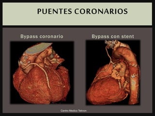 Bypass coronario Bypass con stent
PUENTES CORONARIOS
Centro Medico Teknon
 