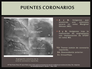 Angiografía selectiva de la
arteria coronaria izquierda.
 A y B: Imágenes que
muestran una estenosis
severa en rama Marginal
Obtusa (MO).
 C y D: Imágenes tras la
realización de angioplastia
con implantación de STENT
en rama MO.
TCI: Tronco común de coronaria
izquierda.
DA: Descendente anterior.
Cx: Circunfleja.
PUENTES CORONARIOS
Mª Pilar Portero Pérez; Mª Jesús Pinilla Lozano Infarto agudo de miocardio tras reacción anafiláctica por picadura de avispa, Rev. Aragonesa
de CardiologiaVolumen 9 - Número 1 - Mayo 2006
 
