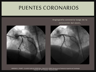Cinecoronar iog ra f í a que muestra importan te carga
trombótic a e n e l sitio de la le sión de la arte ria
descendente anterior.
Angiografía coronaria luego de la
colocación del stent.
PUENTES CORONARIOS
MARIANO C. RUBIO*, CLAUDIO SUELDO PEREYRA†, CARLOS R. RUBIO Revista de la Federación Argentina de Cardiología
Volumen 37 - Nº 4 Octubre - Diciembre 2008
 