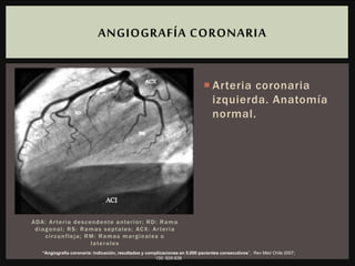ADA: Arteria descendente anterior; RD: Rama
diagonal; RS: Ramas septales; ACX: Arteria
circunfleja; RM: Ramas marginales o
laterales
 Arteria coronaria
izquierda. Anatomía
normal.
ANGIOGRAFÍA CORONARIA
“Angiografía coronaria: indicación, resultados y complicaciones en 5.000 pacientes consecutivos”, Rev Méd Chile 2007;
135: 829-838
 