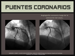 Rip O Rama arterias coronarias | PPTX