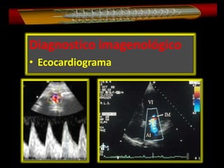 Diagnostico imagenológico
• Ecocardiograma

 