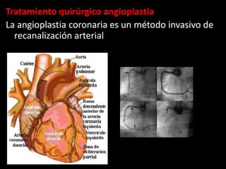 Tratamiento quirúrgico angioplastia
La angioplastia coronaria es un método invasivo de
recanalización arterial

 