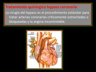 Tratamiento quirúrgico bypass coronario
La cirugía del bypass es el procedimiento estándar para
tratar arterias coronarias críticamente estrechadas o
bloqueadas y la angina incontrolable.

 