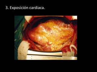 3. Exposición cardiaca.

 