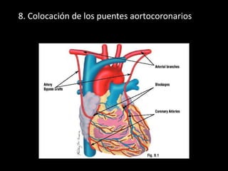 8. Colocación de los puentes aortocoronarios

 