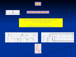 CRITERIOS DE IMA EKG Elevación del ST    0.2mV desde V1 hasta V3 y 0.1 mV en otras derivadas Y  Bloqueo de rama izquierda nuevo EKG 