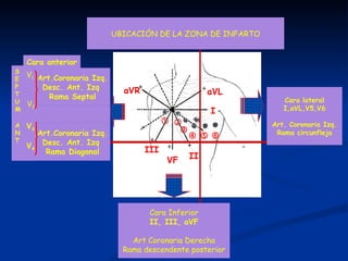 UBICACIÓN DE LA ZONA DE INFARTO       aVR II III aVL VF I Cara lateral I,aVL,V5,V6 Art. Coronaria Izq. Rama circunfleja V 3 V 4 Art.Coronaria Izq. Desc. Ant. Izq  Rama Septal Art.Coronaria Izq. Desc. Ant. Izq  Rama Diagonal S E P T U M Cara anterior V 1 V 2 A N T Cara Inferior II, III, aVF Art Coronaria Derecha Rama descendente posterior 