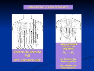 UBICACIÓN DE LA ZONA DE INFARTO V 1     V 4 DEPRESION MARCADA PARED POSTERIOR VENTRICULO IZQUIERDO Art.Coronario Izq. Rama circunfleja O Art.Coronario Der. Rama Desc.Post. Ventriculo derecho V 4 R Art. Coronaria der. 