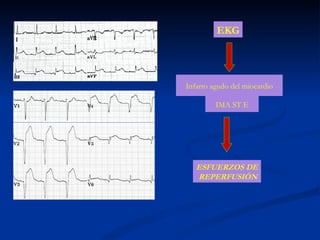 EKG ESFUERZOS DE REPERFUSIÓN Infarto agudo del miocardio IMA ST E 