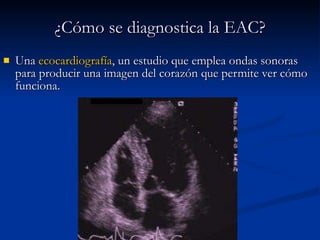 Una  ecocardiografía , un estudio que emplea ondas sonoras para producir una imagen del corazón que permite ver cómo funciona.    ¿Cómo se diagnostica la EAC? 