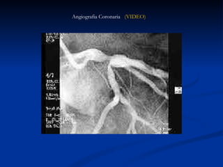 Angiografia Coronaria  (VIDEO) 