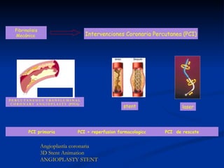 Intervenciones Coronaria Percutanea (PCI) Fibrinolisis Mecánica  PCI primaria PCI + reperfusion farmacologica PCI  de rescate Angioplastía coronaria 3D Stent Animation ANGIOPLASTY STENT P E R C U T A N E O U S   T R A N S L U M I N A L  C O R O N A R Y   A N G I O P L A S T Y   (PTCA) laser stent 