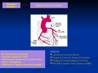 Bypass Aorto coronario En fase aguda es limitada Indicada cuando PCI falla Obstruccion inesperada en cateterismo Shock cardiogenico Disfuncion o ruptura de musculo papilar Fibrinolisis Mecánica  VIDEOS operacion a corazon abierto Cirugía de Corazón Arterias Coronarias Cirugía de Corazón Bypass Coronario  PreOp® Coronary Artery Bypass CABG) 
