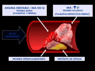 FLUJO SANGUINEO DEPÓSITOS DE LÍPIDOS FISIOPATOLOGIA FLUJO SANGUINEO TROMBO INTRAPLAQUETARIO DEPÓSITO DE LIPIDOS TROMBO INTRAPLAQUETARIO DEPÓSITO DE LÍPIDOS TROMBO INTRALUMINAL FLUJO SANGUINEO TROMBO INTRALUMINAL FLUJO SANGUINEO PROPAGACIÓN DEL TROMBO TROMBO INTRAPLAQUETARIO DEPÓSITO DE LÍPIDOS ANGINA INESTABLE / IMA NO Q TROMBO MURAL (PLAQUETAS Y FIBRINA) IMA :  ST TROMBO OCLUSIVO (PLAQUETAS,ERITROCITOS,FIBRINA )  FLUJO SANGUINEO TROMBO INTRAPLAQUETARIO DEPÓSITO DE LÍPIDOS 
