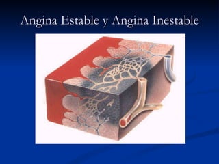 Angina Estable y Angina Inestable 