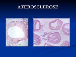 ATEROSCLEROSE 