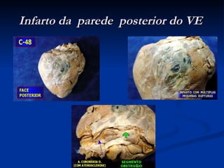 Infarto da  parede  posterior do VE   