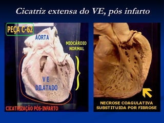 Cicatriz extensa do VE, pós infarto 