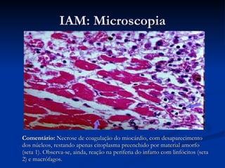 IAM: Microscopia Comentário:  Necrose de coagulação do miocárdio, com desaparecimento dos núcleos, restando apenas citoplasma preenchido por material amorfo (seta 1). Observa-se, ainda, reação na periferia do infarto com linfócitos (seta 2) e macrófagos. 
