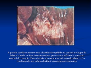 A parede cardíaca mostra uma cicatriz (área pálida ao centro) no lugar do infarto curado. A área marrom-escuro que cerca o infarto é o músculo normal do coração. Essa cicatriz tem meses ou até anos de idade, e é o resultado de um infarto devido à aterosclerose coronária. 