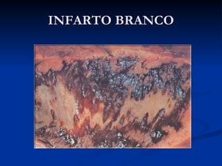 INFARTO BRANCO 