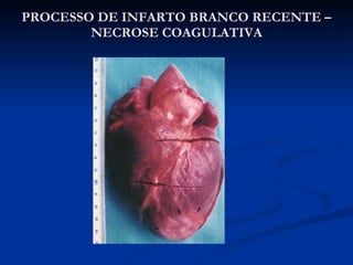 PROCESSO DE INFARTO BRANCO RECENTE – NECROSE COAGULATIVA 