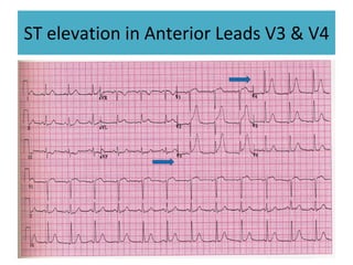ST elevation in Anterior Leads V3 & V4 