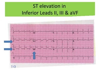 ST elevation in  Inferior Leads II, III & aVF 