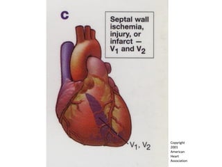 Copyright  2001  American  Heart  Association 