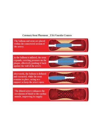 What is an Angioplasty Procedure | USA Vascular Centers