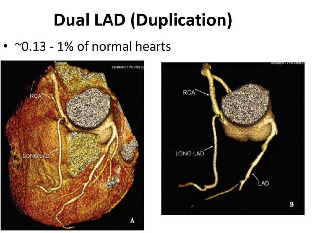 Coronary anatomy and angiographic views | PPTX