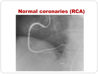 Normal coronaries (RCA)
 