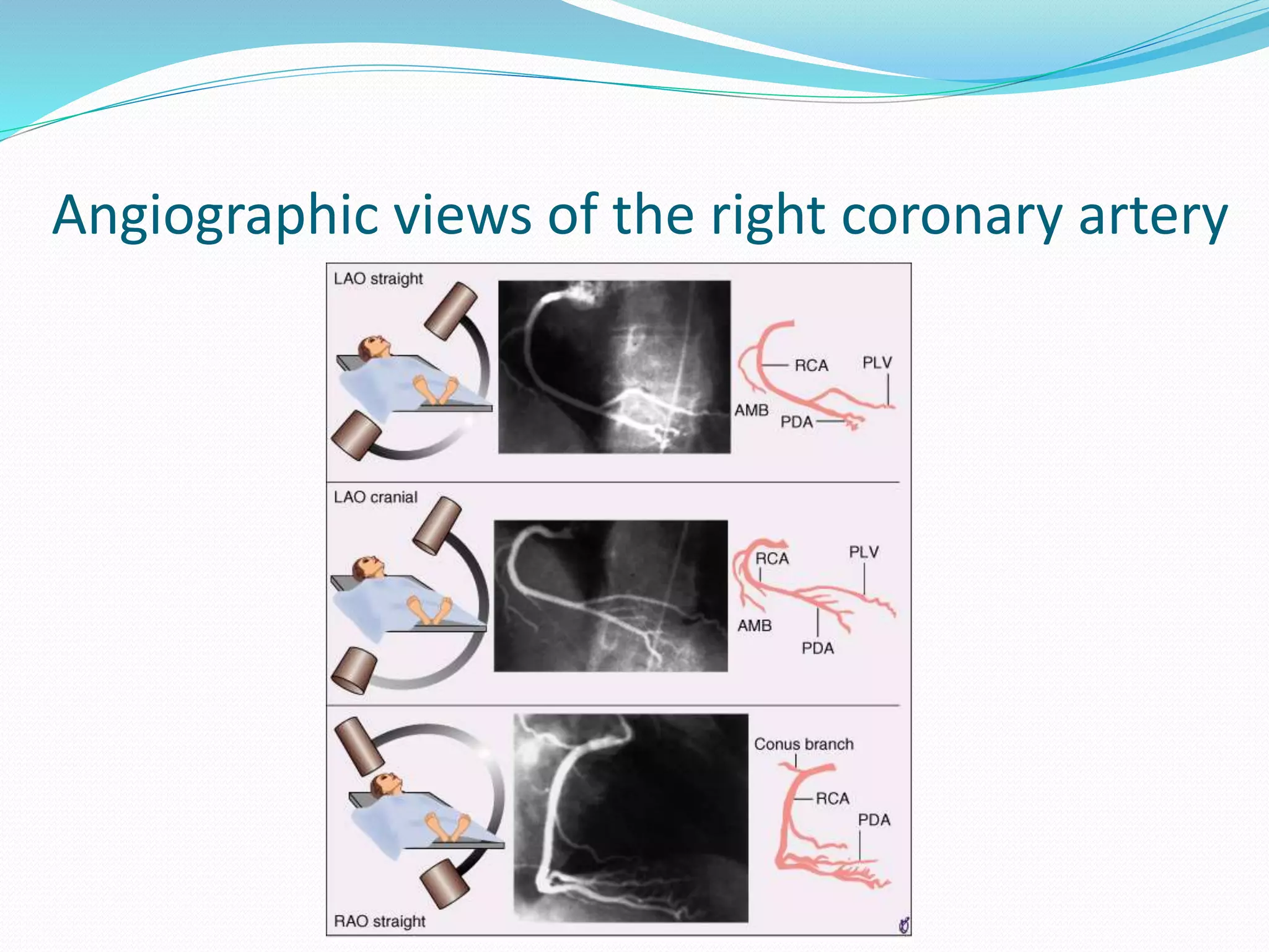 Coronary angiography | PPTX