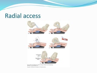 Access Rra Angiogram Coronary angiography | PPTX