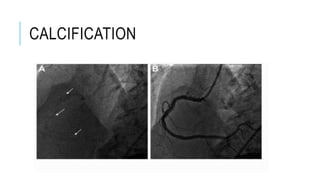 Coronary angiography | PPTX