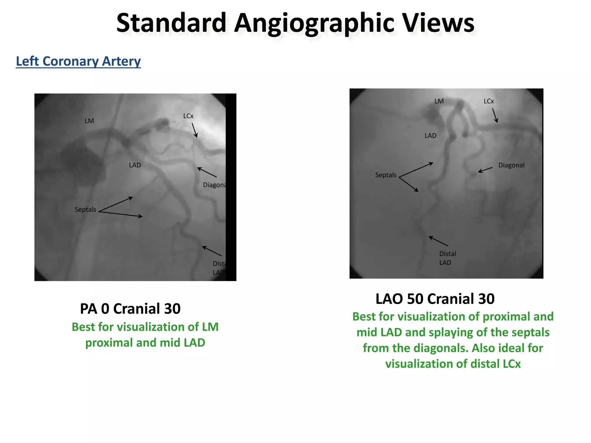 CORONARY ANGIOGRAPHY.pptx