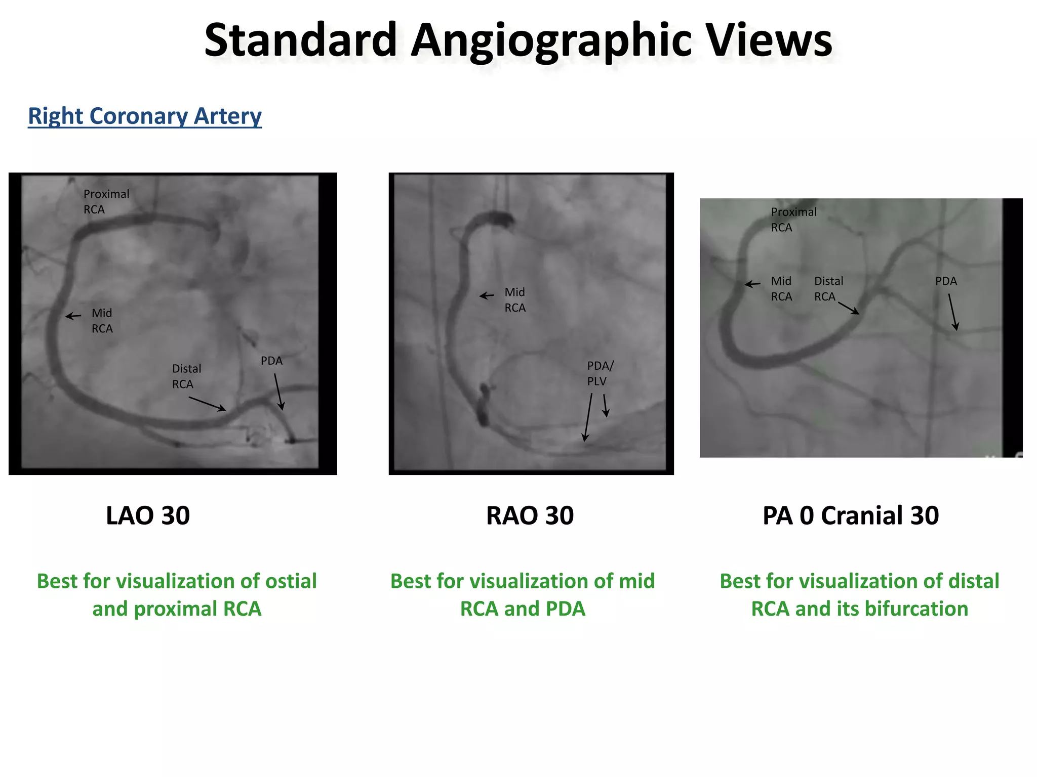 CORONARY ANGIOGRAPHY.pptx