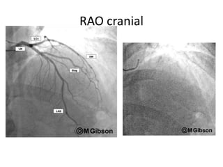 coronaryangiography-220330142539 (1).pdf