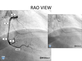 coronaryangiography-220330142539 (1).pdf