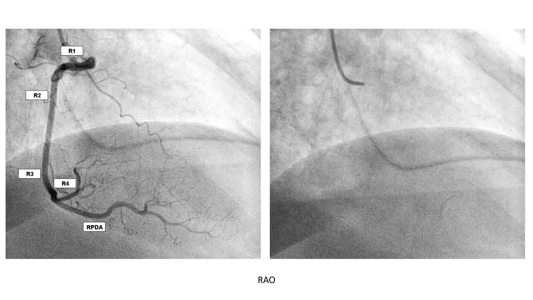 CORONARY ANGIOGRAPHY INTERPRET(Coronary Angios).pptx