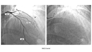 CORONARY ANGIOGRAPHY INTERPRET(Coronary Angios).pptx
