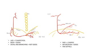 CORONARY ANGIOGRAPHY INTERPRET(Coronary Angios).pptx